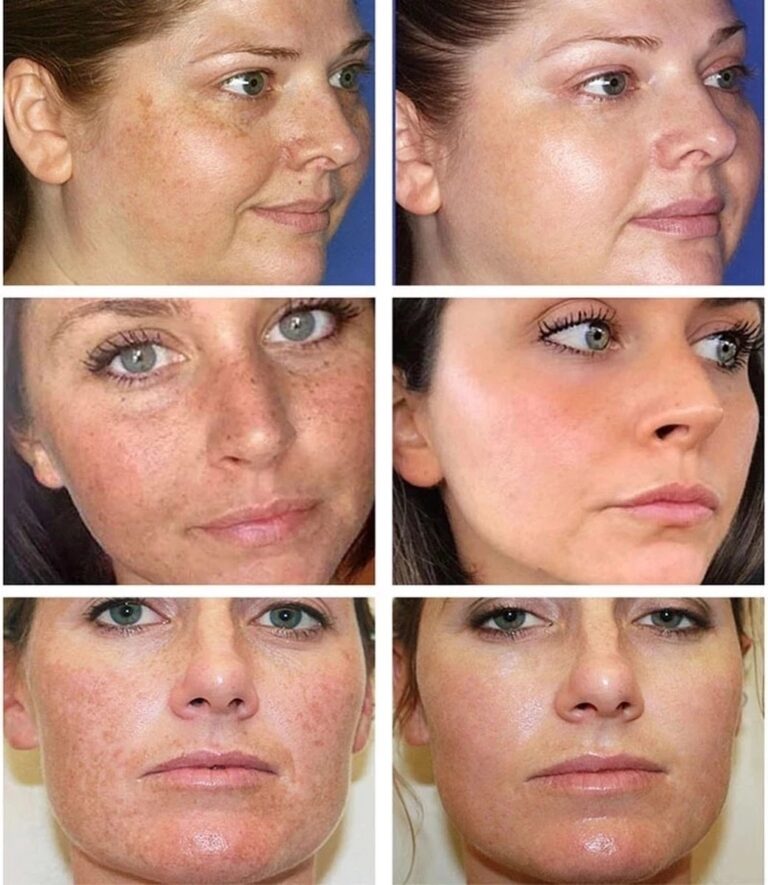 Remove Brown Spots | Freckle Cream | Pigmentation Spot Remover