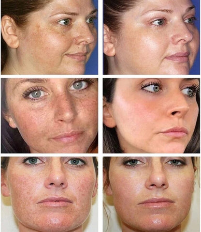 Remove Brown Spots | Freckle Cream | Pigmentation Spot Remover