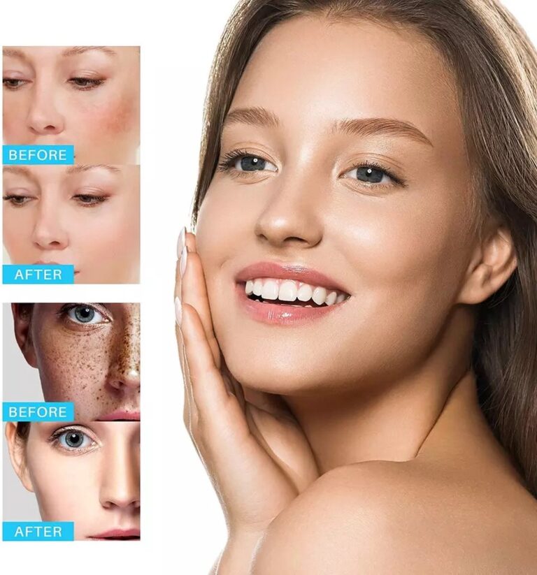 Remove Brown Spots | Freckle Cream | Pigmentation Spot Remover