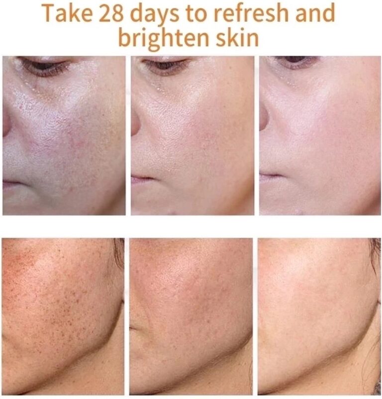 Remove Brown Spots | Freckle Cream | Pigmentation Spot Remover