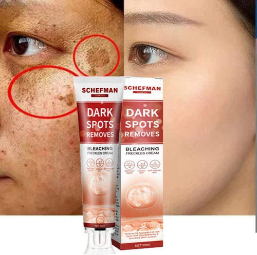 Remove Brown Spots | Freckle Cream | Pigmentation Spot Remover
