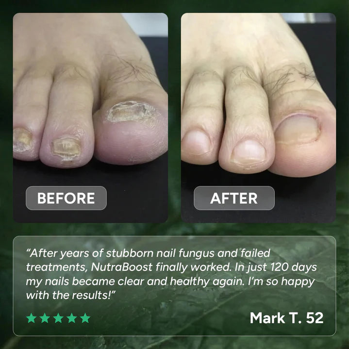 GEL FOR THE TREATMENT OF NAIL FUNGUS